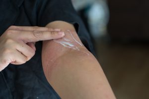 moisturising eczema flare up to sooth irritation
