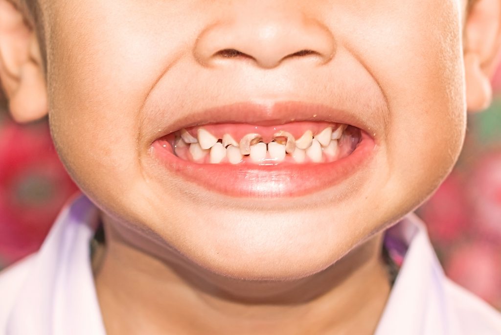 children tooth decay in qatar, dentists