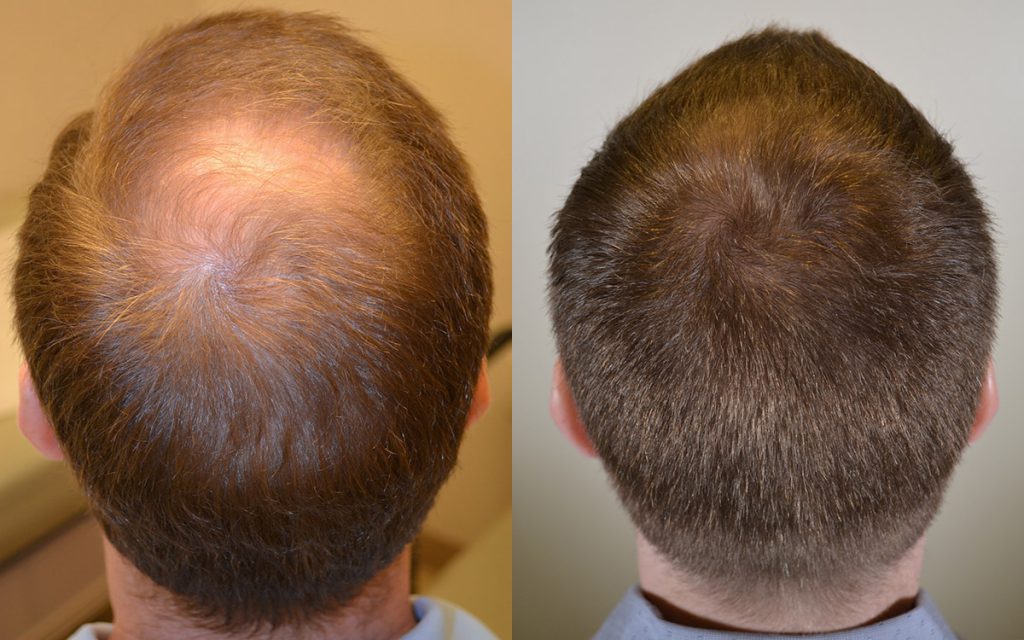 Propecia 15 months non surgical treatment for hair loss 