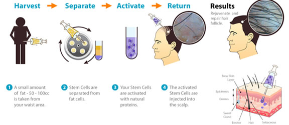 Stem Cell Treatment surgical for hair loss 