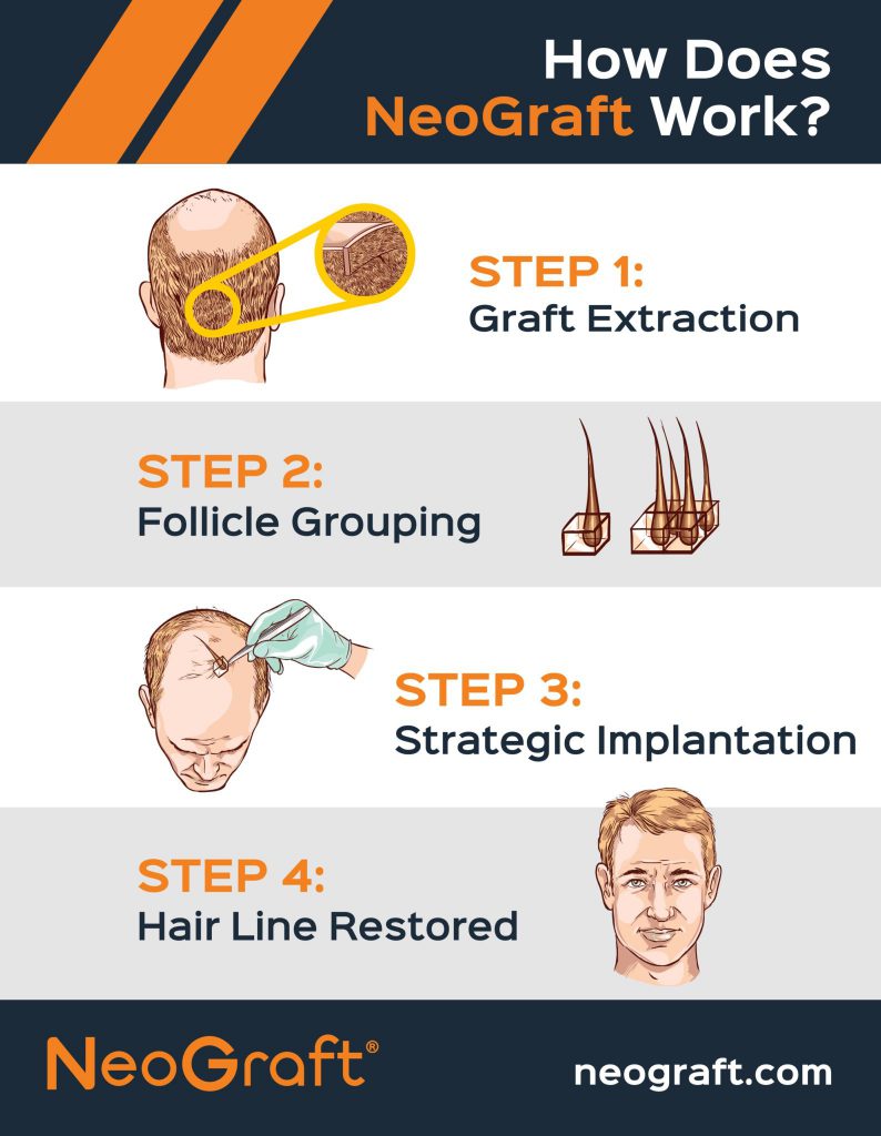 how-it-works-infographic neograft