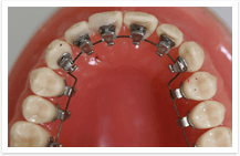 filipino orthodontist in Qatar lingual braces type 