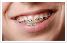 Traditional braces type