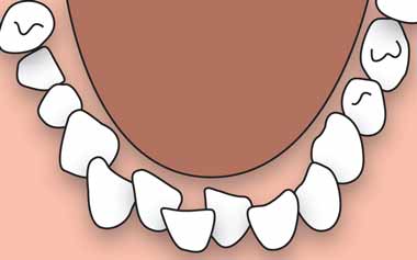 braces clean crowded teeth 