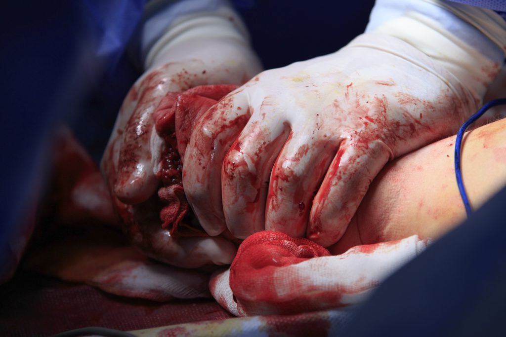bleeding in emergency medicine in doha 