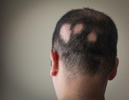 The back shot of an alopecia patient.