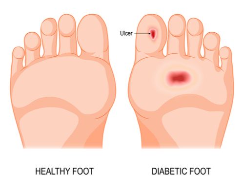 Comparison of a healthy foot and a diabetic foot.