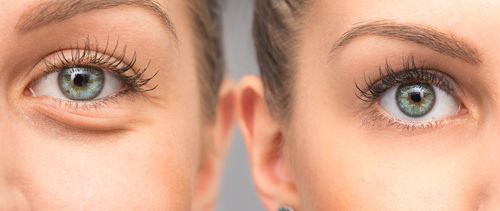 Before and after image showing dermatology treatment for eye puffiness. 
