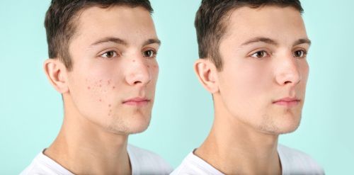 Before and after of a teen boy with acne.
