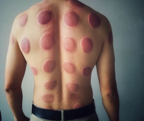 The aftermath of cupping therapy.