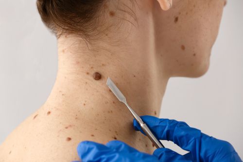 A mole on the neck about be removed at the doctor's clinic.