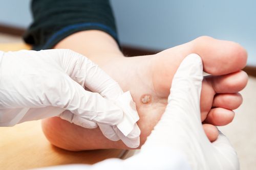 A plantar wart being removed by a professional. 