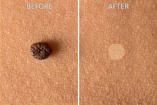 The skin's surface before and after mole removal.