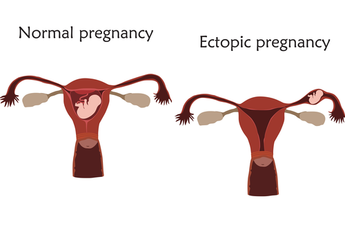 the difference between a healthy and an ectopic pregnancy.