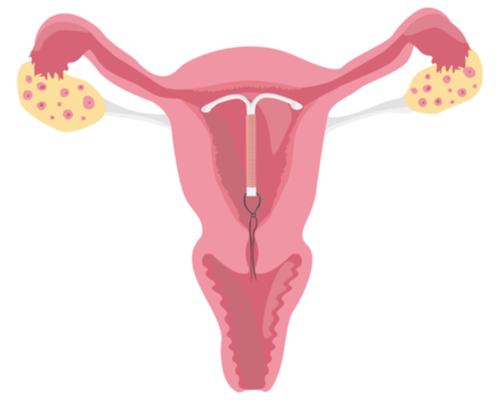 Illustration of an IUD inserted in the uterus.